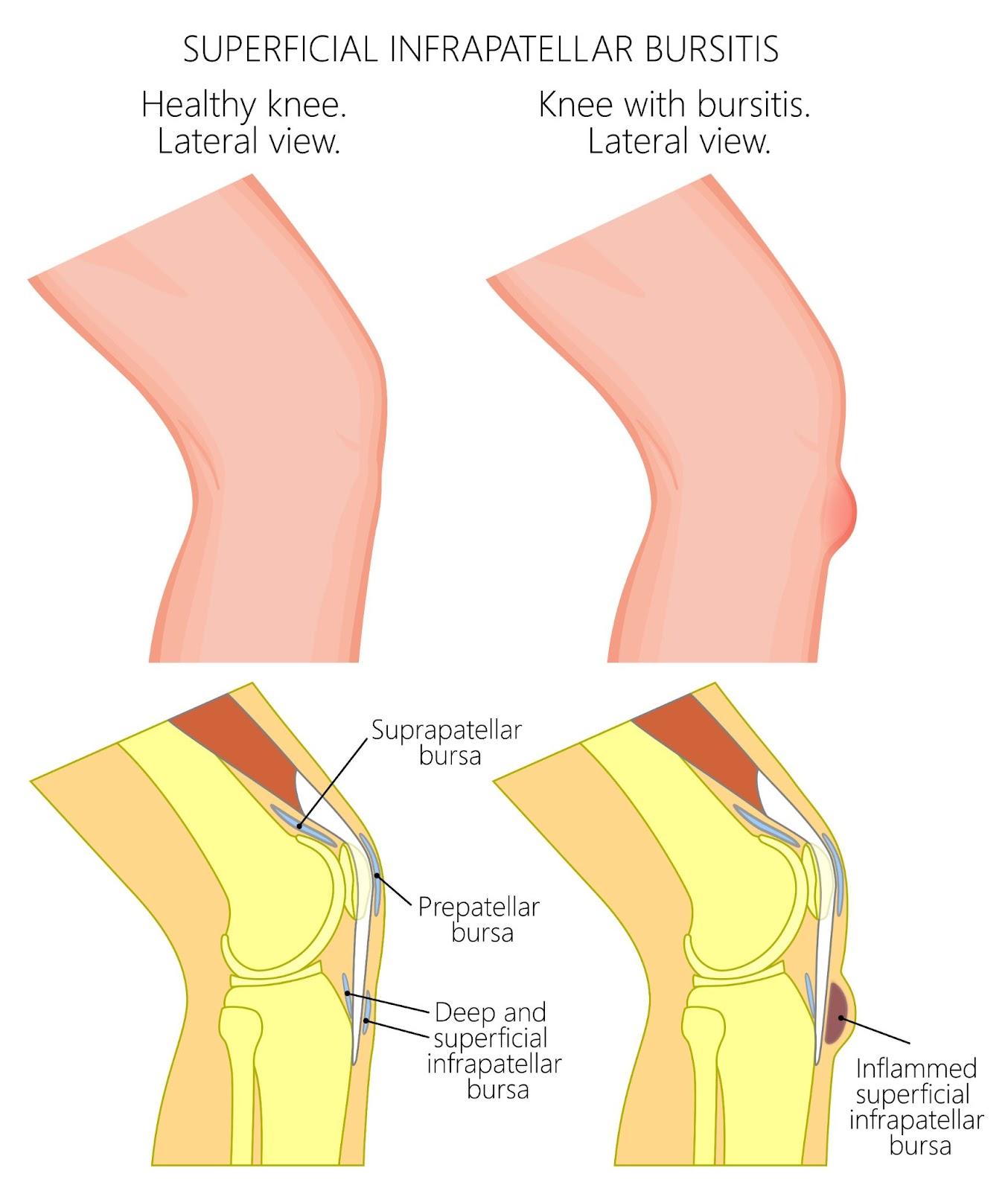 superficial-infrapatellar-bursitis